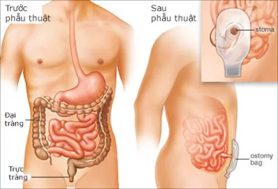 Phẫu thuật cắt đại tràng