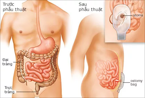 Phẫu thuật cắt đại tràng