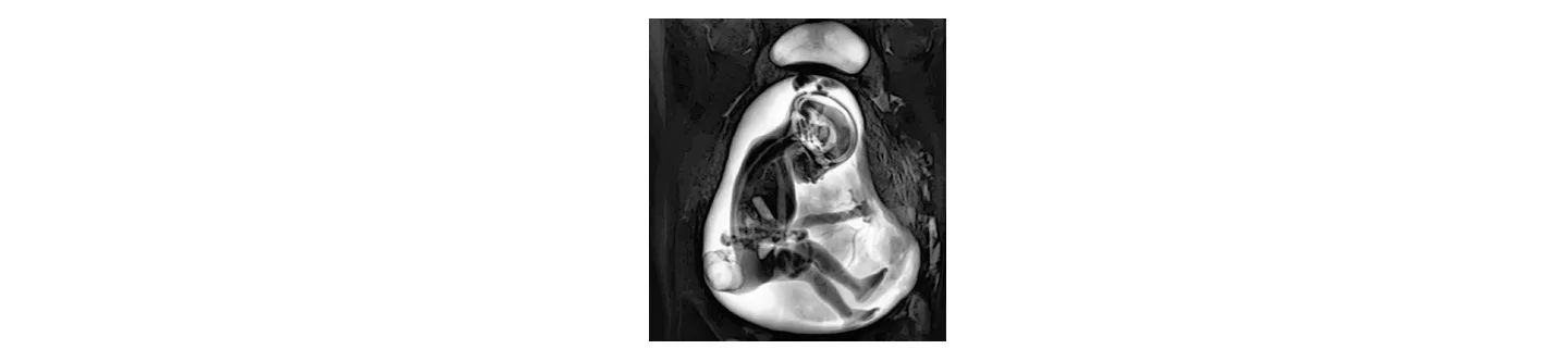 MRI