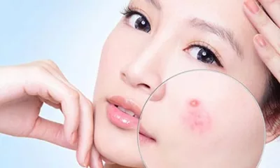 Điều trị mụn trứng cá
