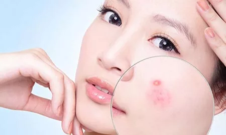 Điều trị mụn trứng cá