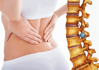 Thoát vị đĩa đệm