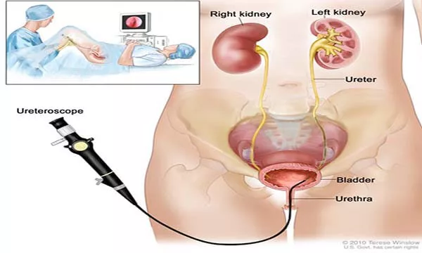 Nội soi niệu quản trong chẩn đoán và điều trị bệnh lý niệu quản