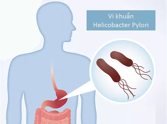 Bạn đã nhiễm vi khuẩn HP : dưới đây là một số thông tin bổ ích dành cho bạn!