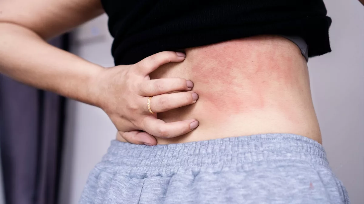 Top 7 cách chữa nổi mề đay sau sinh, bao lâu thì hết?