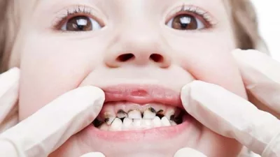 Tìm hiểu về sâu răng