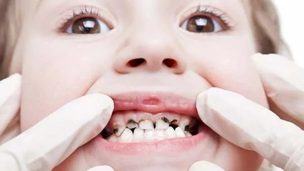 Tìm hiểu về sâu răng