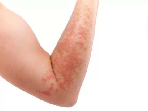 Da con bạn có bị ngứa và mẩn đỏ không? Đó có thể là viêm da cơ địa!