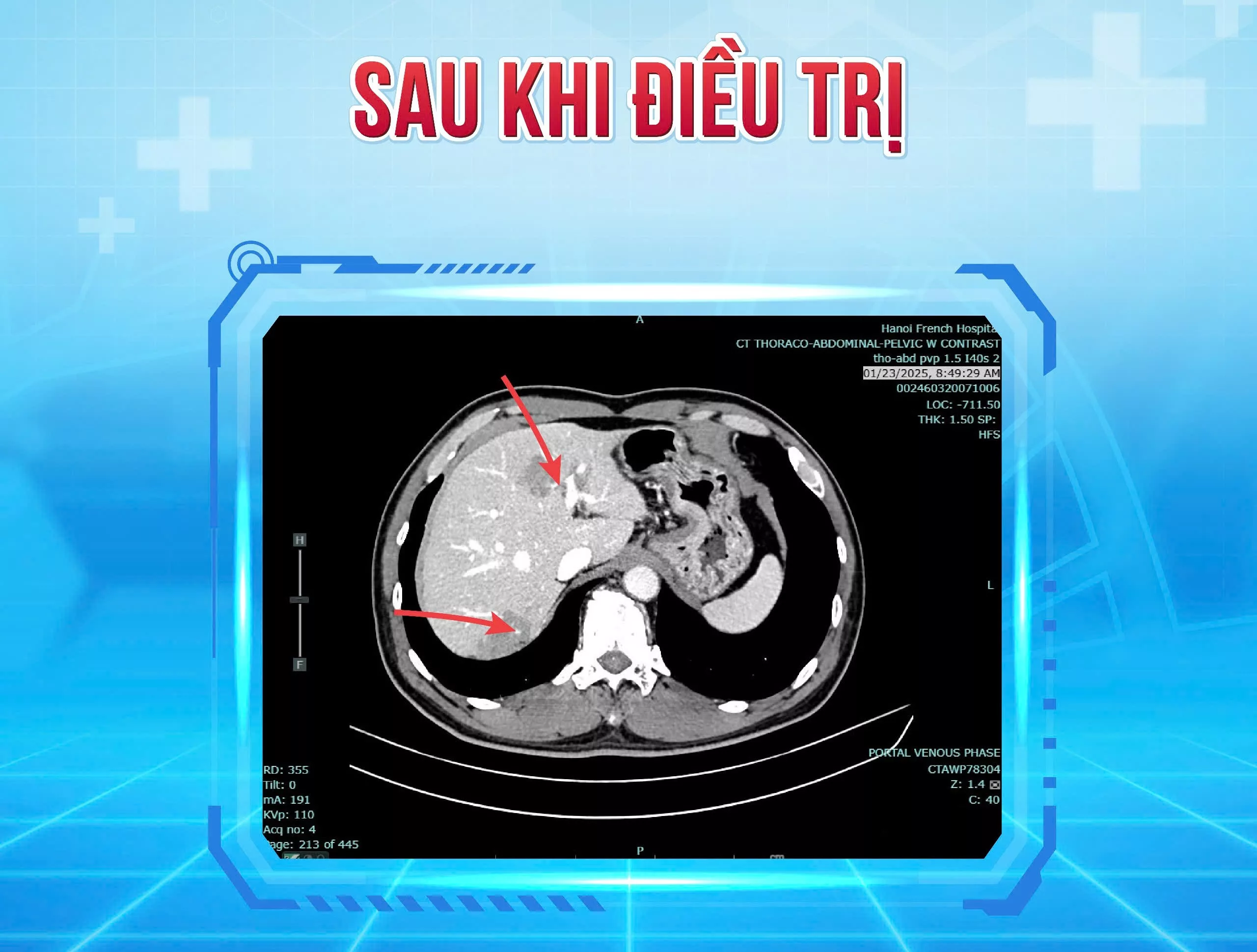 sau dieu tri