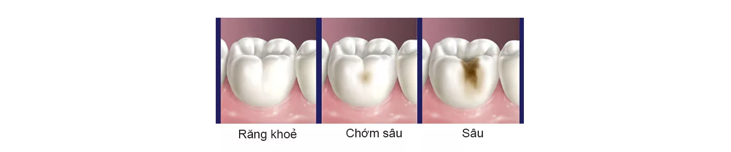 sâu răng
