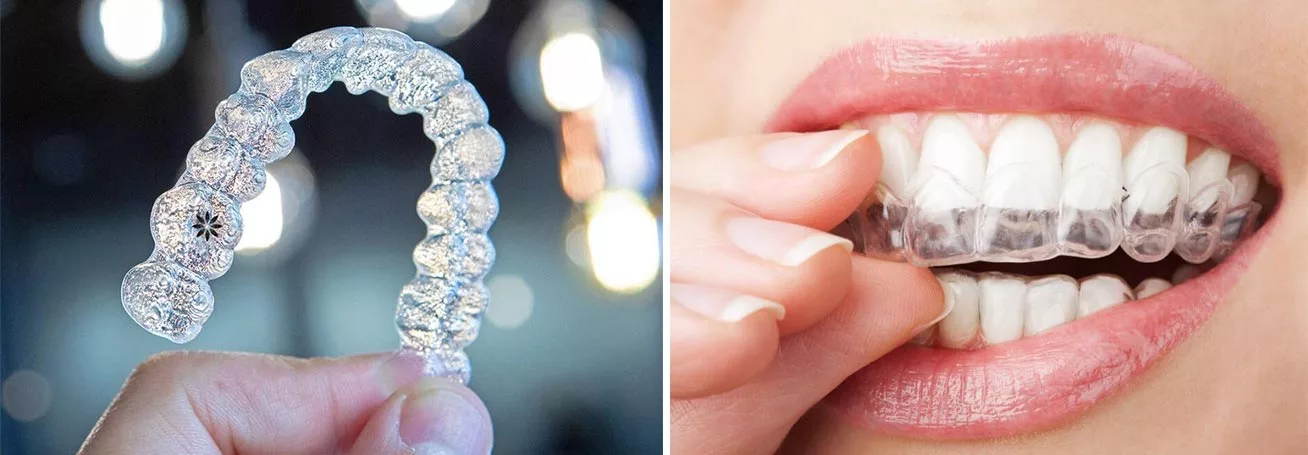 Invisalign