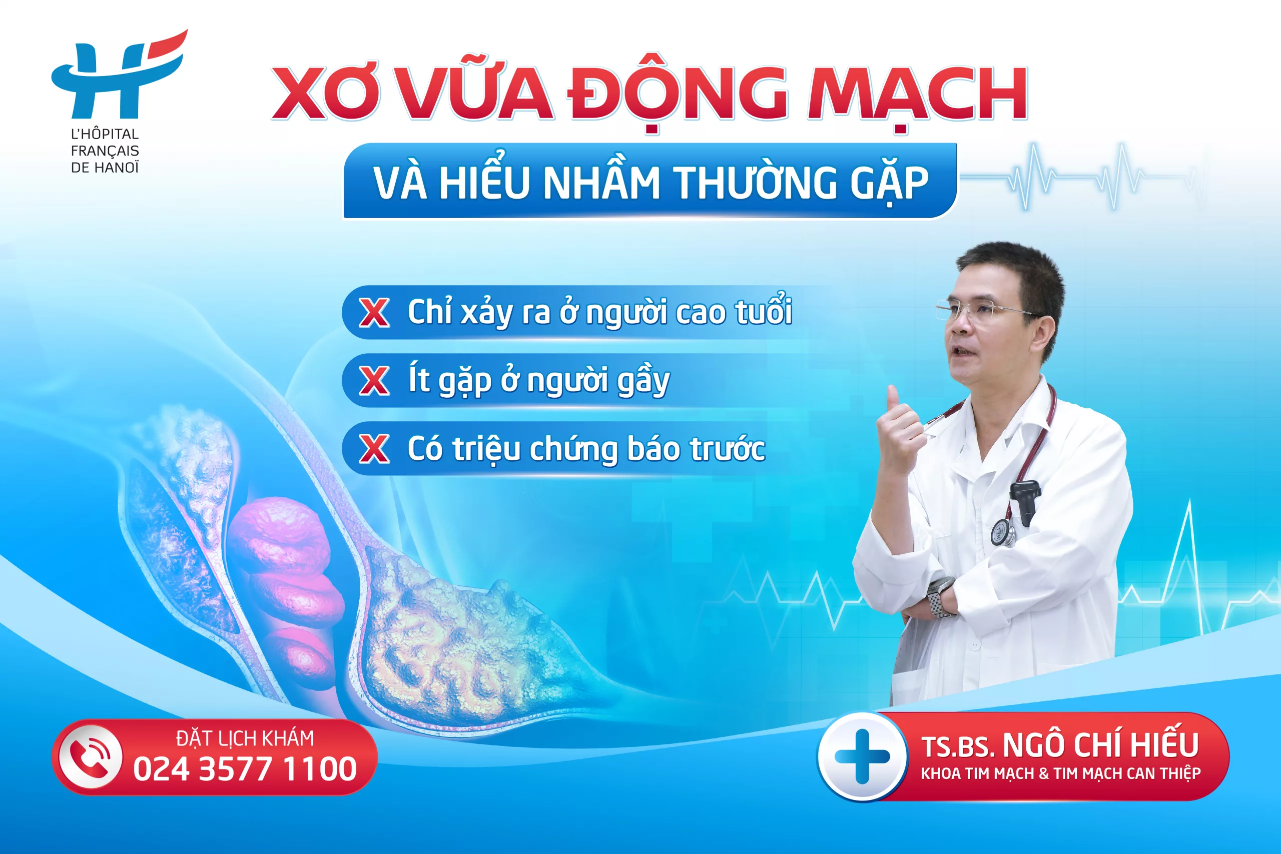 XƠ VỮA ĐỘNG MẠCH VÀ NHỮNG HIỂU NHẦM THƯỜNG GẶP