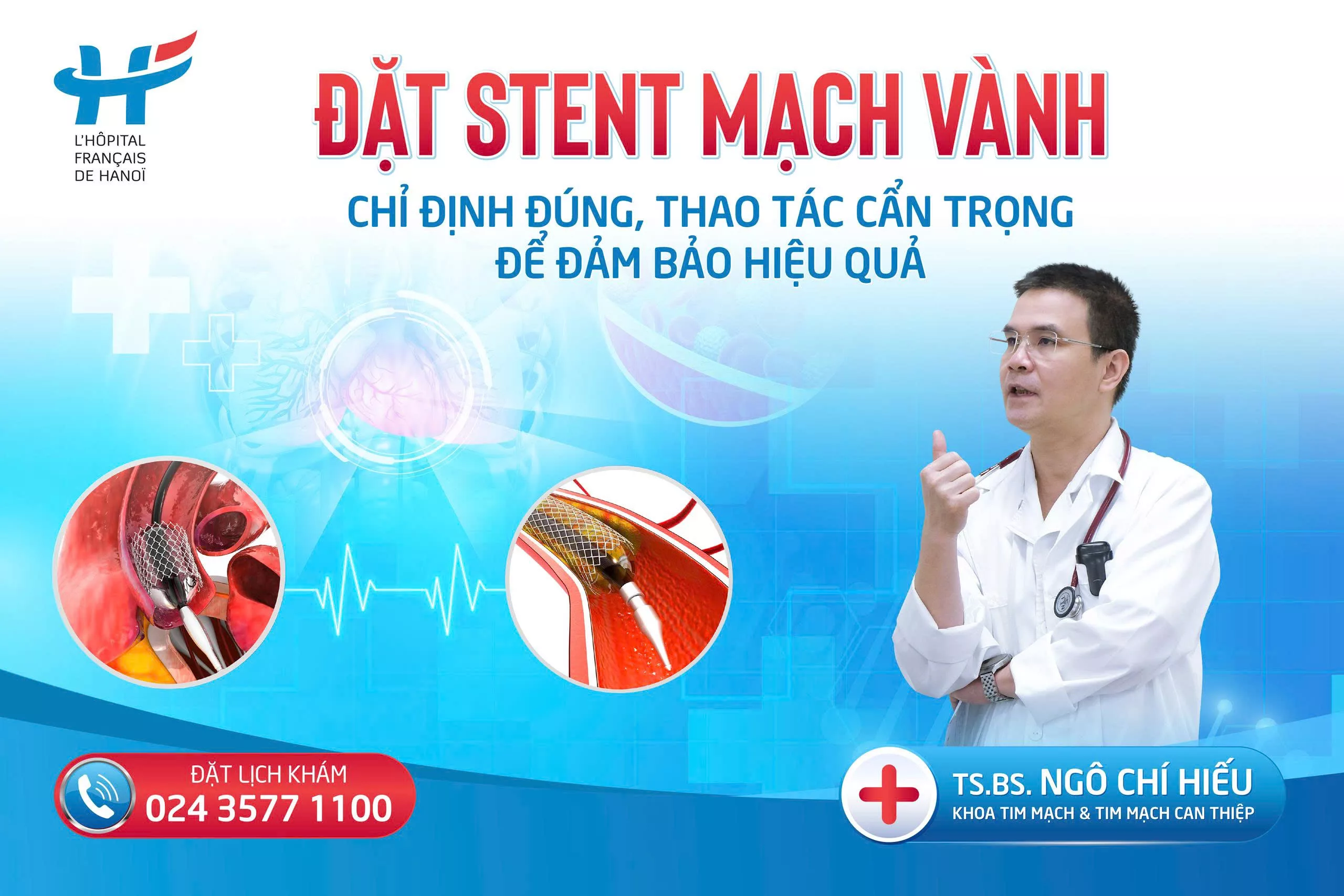 ĐẶT STENT MẠCH VÀNH &#8211; CHỈ ĐỊNH ĐÚNG, THAO TÁC CẨN TRỌNG ĐỂ ĐẢM BẢO HIỆU QUẢ