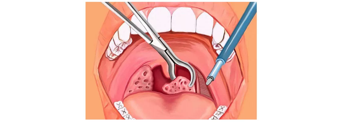Cắt amidan bằng sóng cao tần