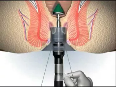 Longo – a surgical treatment for haemorrhoids