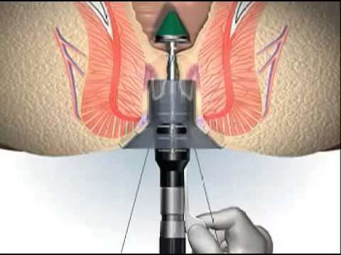 Longo – a surgical treatment for haemorrhoids