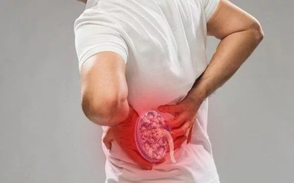 Sỏi tiết niệu: Chớ coi thường