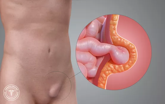 Hernia treatment by laparoscopic surgery