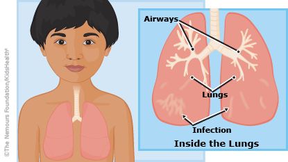 viêm phổi